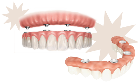 Dentiers-Implantologie-Clinique_dentaire_Maguire